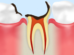C4　歯根のむし歯