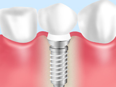 インプラント