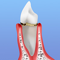 軽度の歯周炎