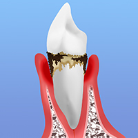 中等度の歯周炎