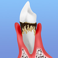 重度の歯周炎